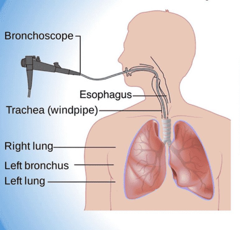 Bronchoscopy procedure diagram showing bronchoscope insertion through airways